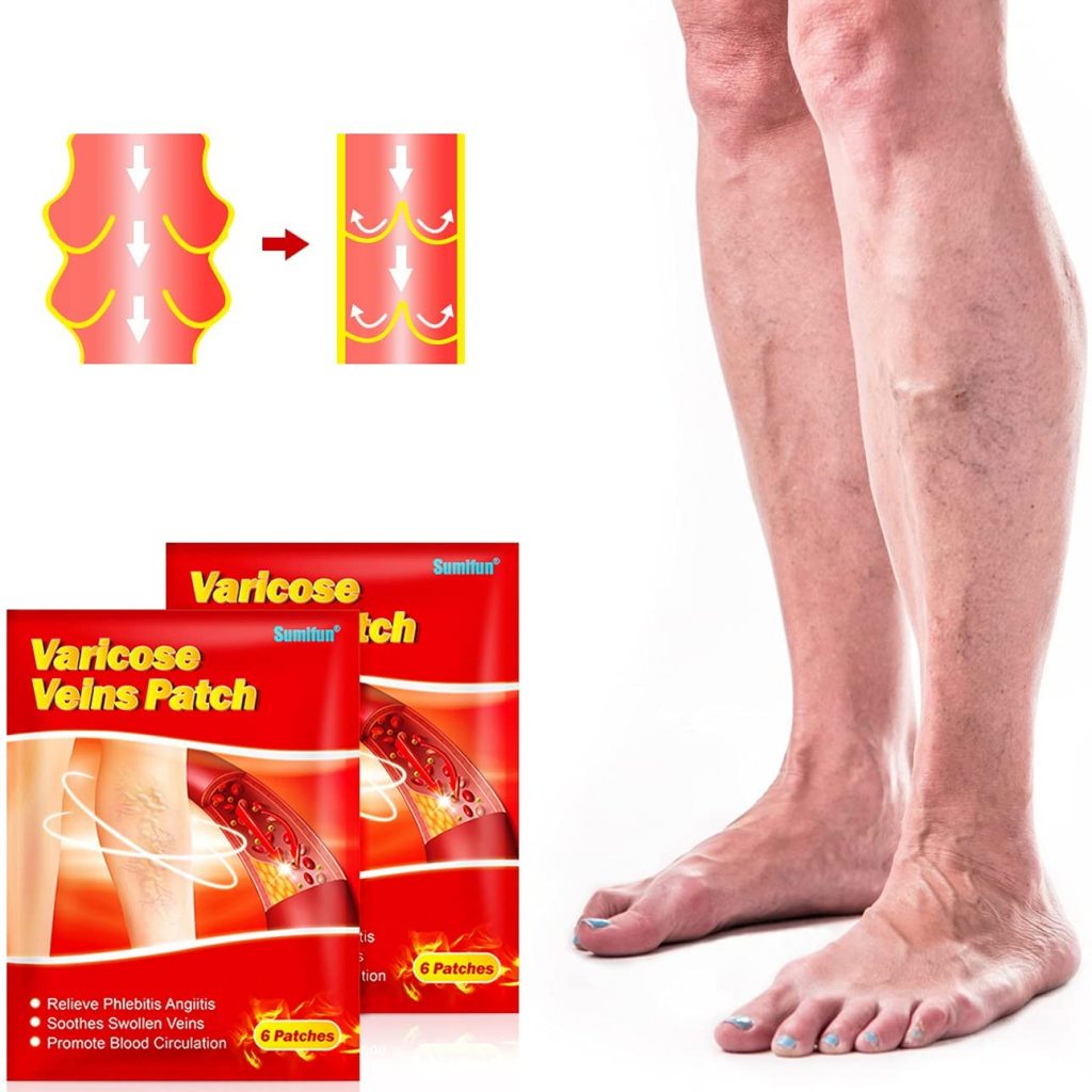 flasteri za prosirene vene